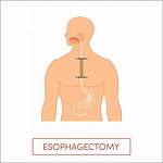 Esophagostomy