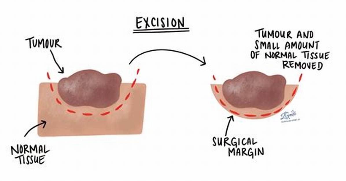 Excision