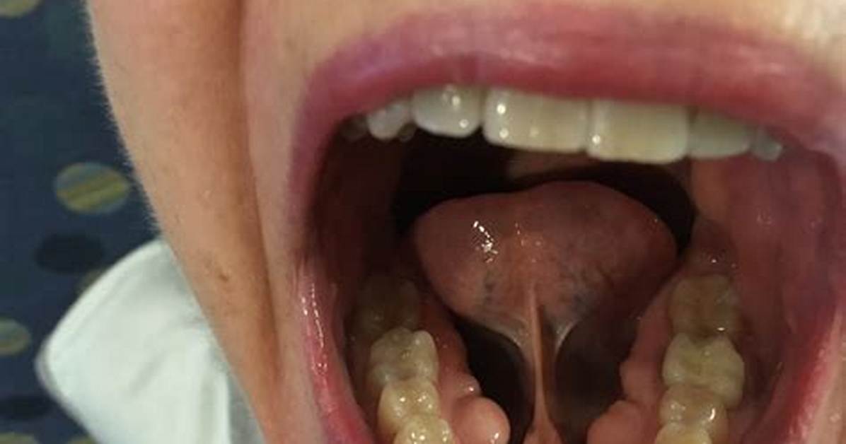 Extra Bone in Mouth
