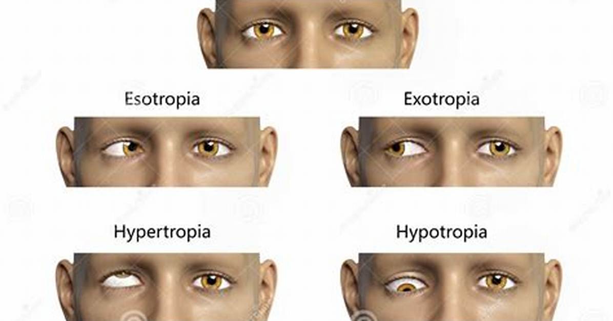 Eye Deviation