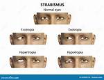 Eye Deviation