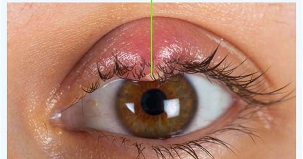 Eyelid Problem