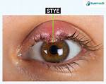 Eyelid Problem