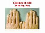 Fingernails Spooning