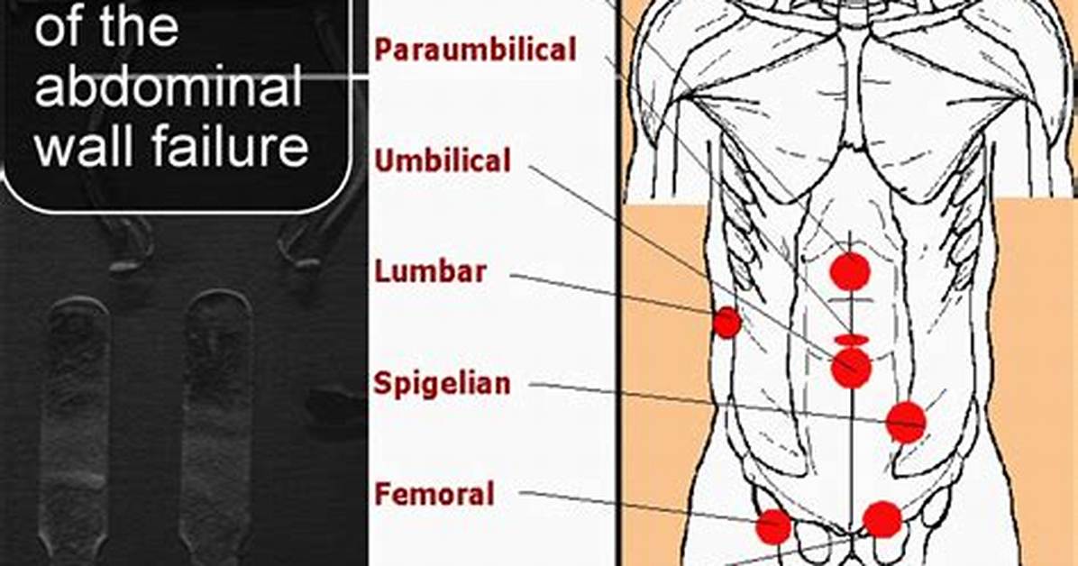 Flank Hernia