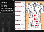 Flank Hernia