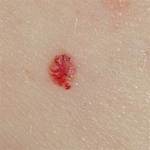 Flat Cherry Angioma