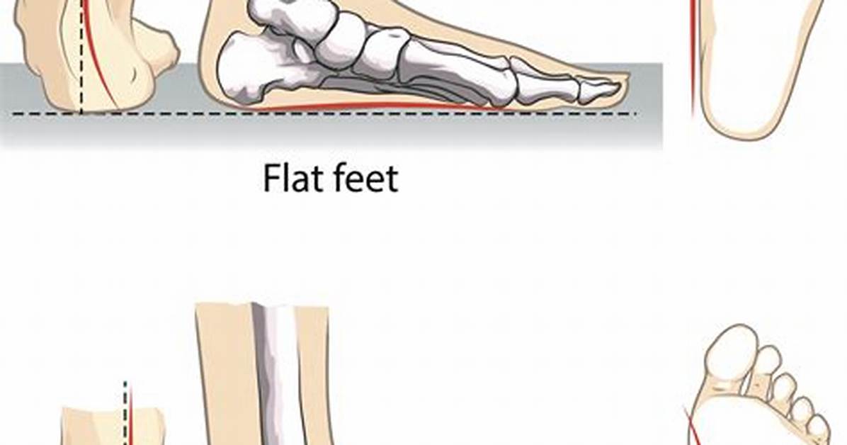 Flat Feet