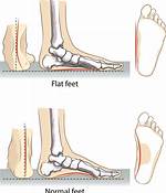 Flat Feet