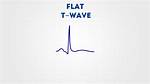 Flat T Waves