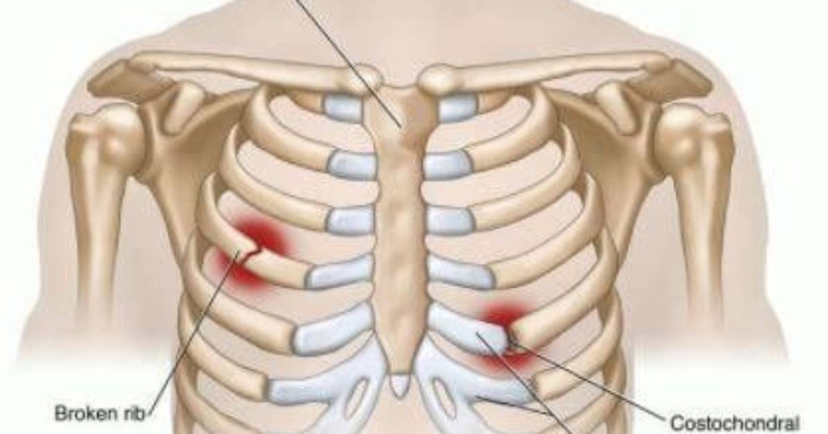 For a Dislocated Rib?