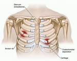 For a Dislocated Rib?