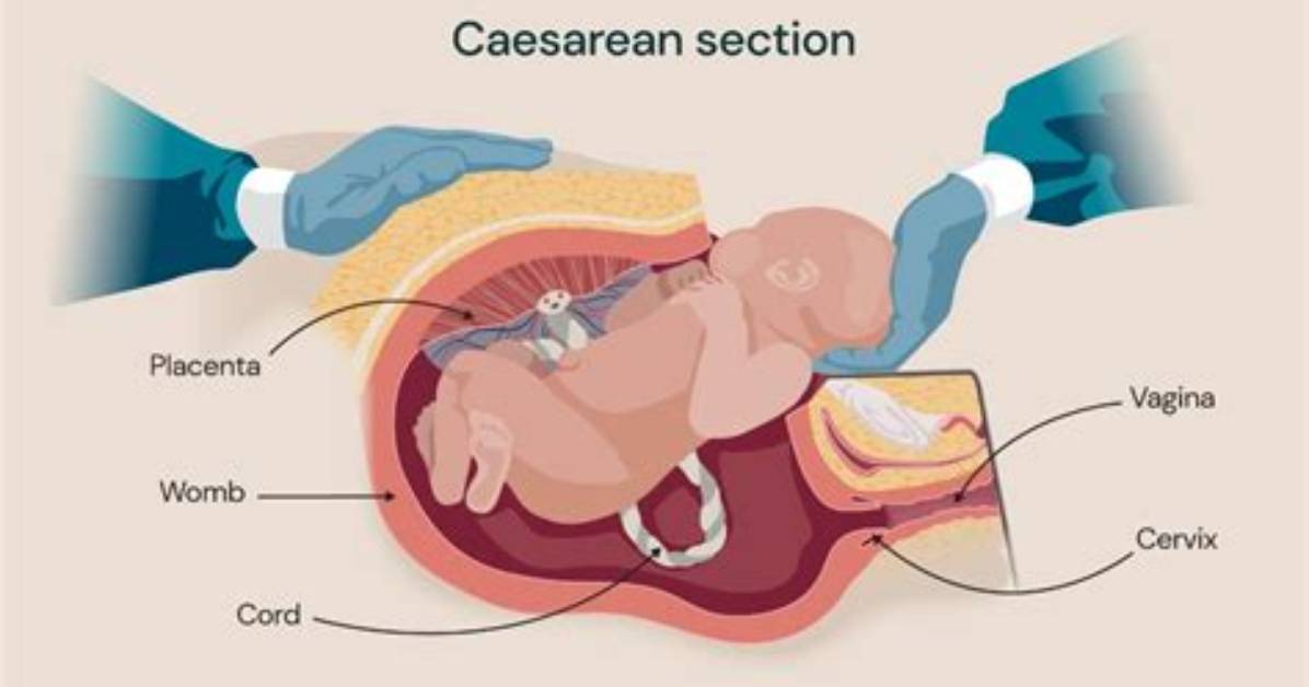 For Elective Caesarean Section?