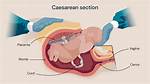 For Elective Caesarean Section?