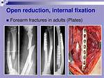 For Open Reduction Internal Fixation?