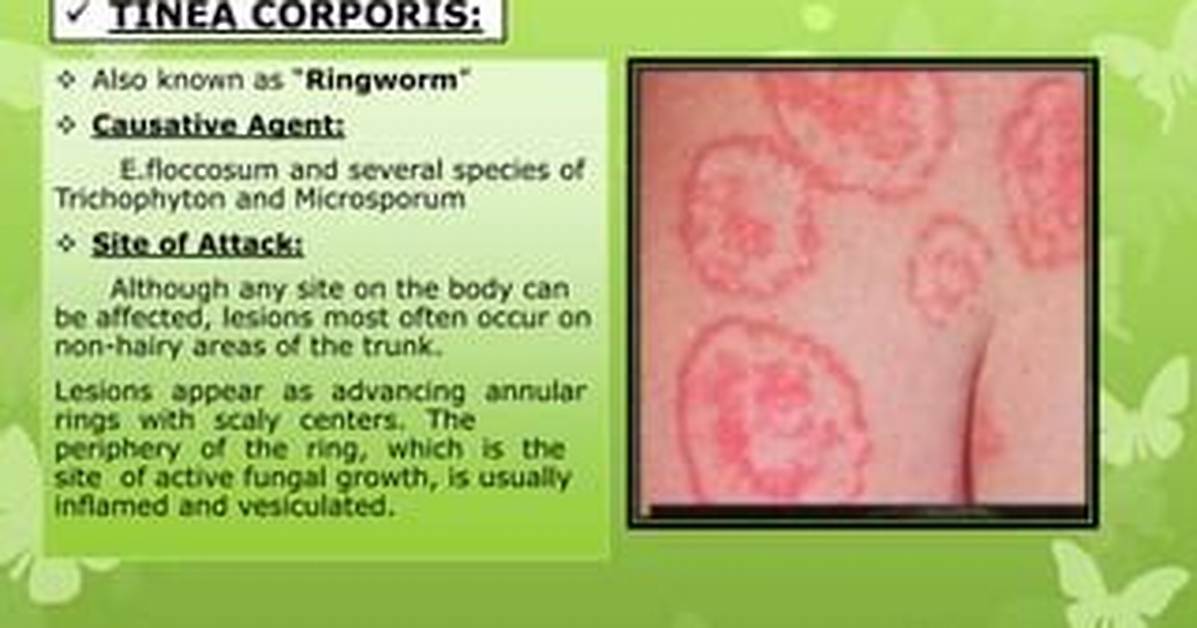 For Ringworm Causative Agent Is?