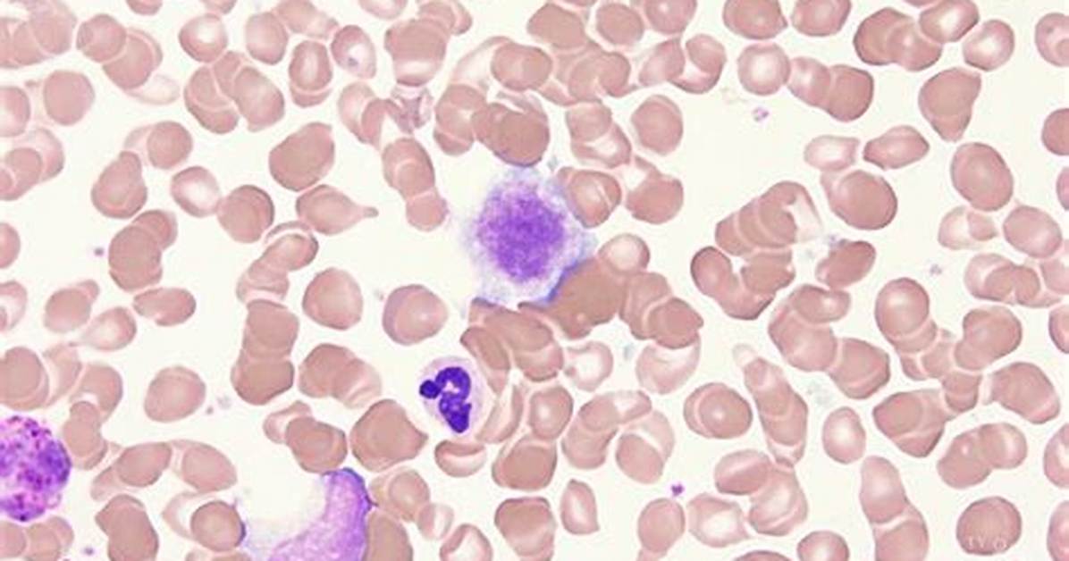 Giant Platelets
