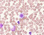 Giant Platelets