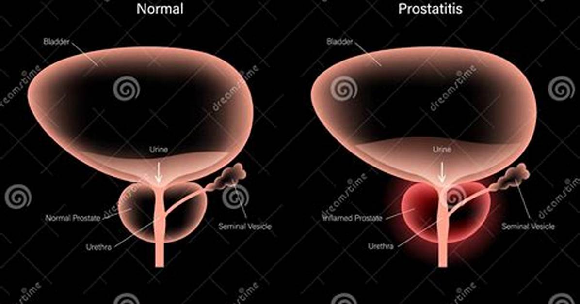 Ginger for Prostatitis - Statcare