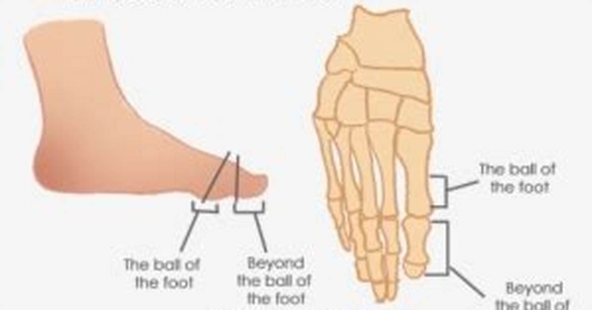 Hallux Amputation