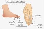 Hallux Amputation