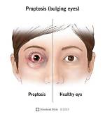 Has a Bulging Eye?
