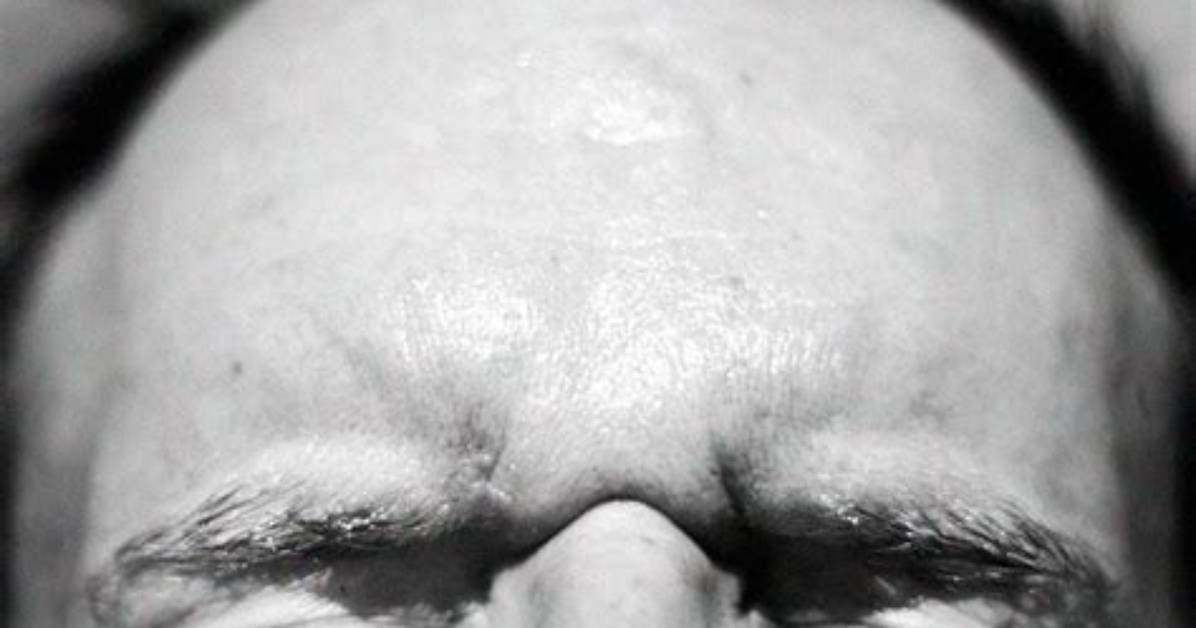 Has a Bulging Forehead?