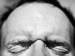 Has a Bulging Forehead?
