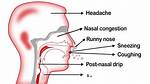 Has a Congested Nose?