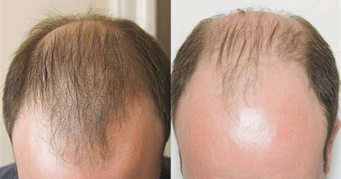 Has Balding Ever Reverse?