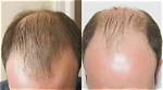 Has Balding Ever Reverse?