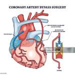 ___-Heart Surgery