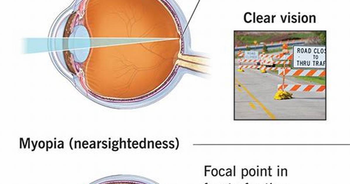 High Myopia Video