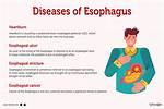 How Anxiety Causes Esophagus Problems