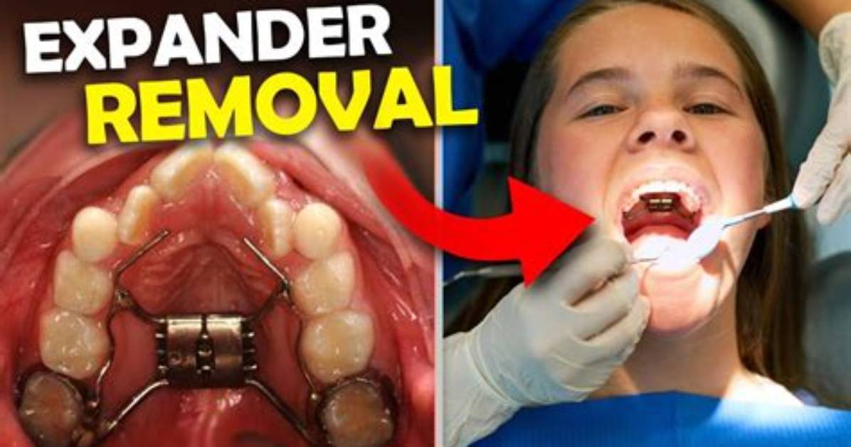 How Are Expanders Removed?
