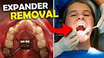 How Are Expanders Removed?