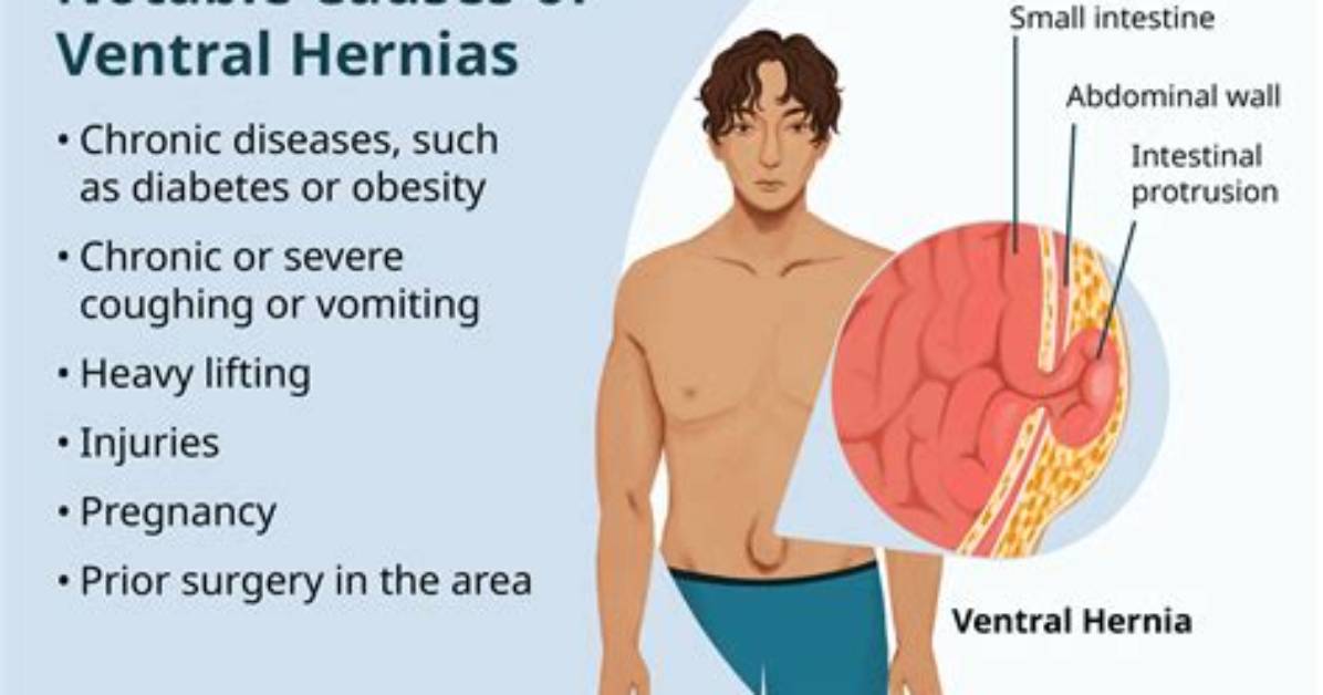 How Bph Cause Hernia?