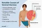 How Bph Cause Hernia?