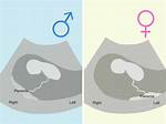 How Can You Tell If a Baby Has a Mild Down Syndrome?