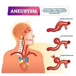 How Common Are Aneurysms?