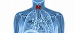 How Common Are Thyroidectomies?