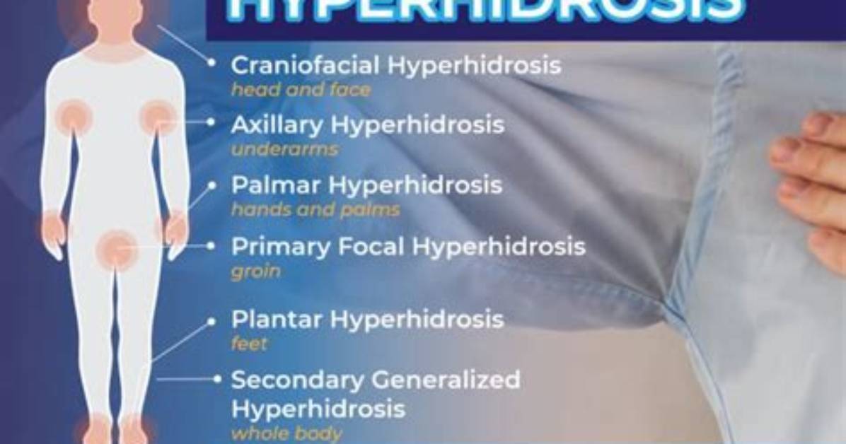 How Common Is Hyperhidrosis?