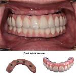 How Dentures Are Fixed?