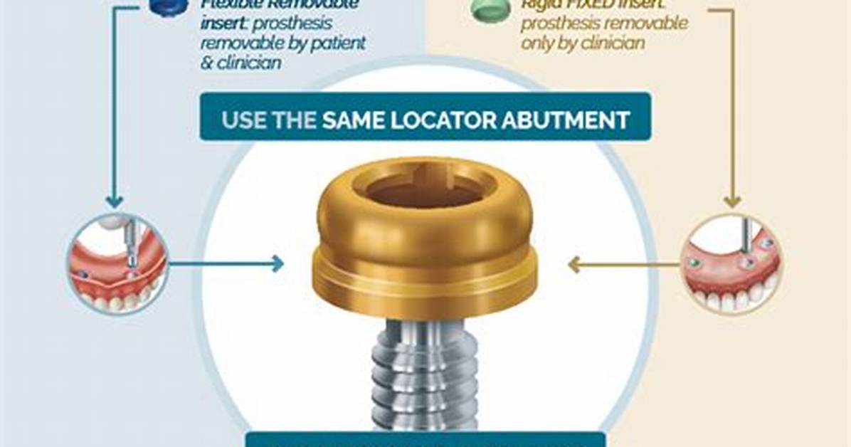 How Do Abutment Clips Work