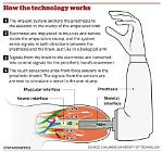 How Do Bionic Arms Work?