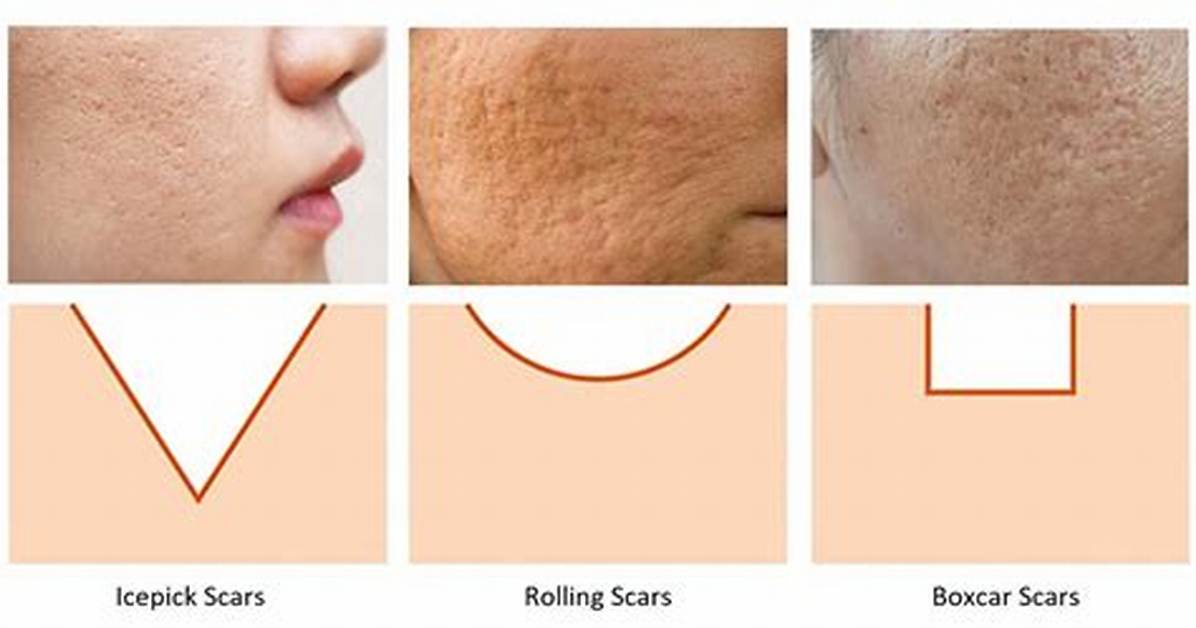 How Do Boxcar Scars Form?