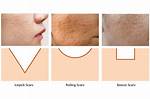 How Do Boxcar Scars Form?