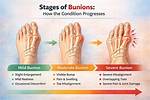 How Do Bunions Form?