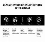 How Do Calcifications Form?