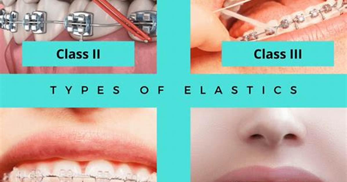 How Do Elastics Work Braces?